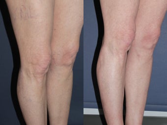 Sclerotherapy Before and After before 1033922
