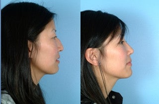 Reduction of Hump before 662853