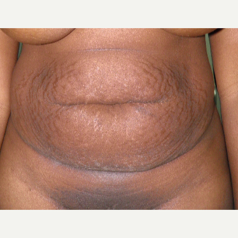 35-44 year old woman treated with Tummy Tuck before 3122950