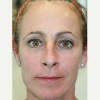 51 year old woman treated with Juvederm Voluma, Restylane, and Botox (Liquid Facelift) after 3748040