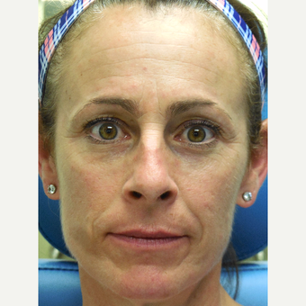 51 year old woman treated with Juvederm Voluma, Restylane, and Botox (Liquid Facelift) before 3748040