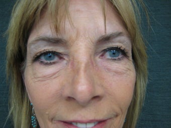 Female underwent upper and lower eyelidplasty under local before 1111534