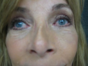 Female underwent upper and lower eyelidplasty under local after 1111534