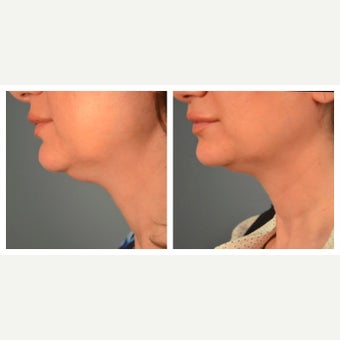 45-54 year old woman treated with Kybella after 2095843