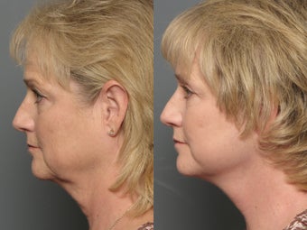 Brow Lift, Facelift & Lower Eyelid Surgery 338628
