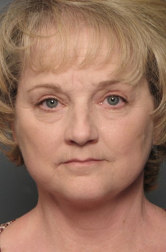 Brow Lift, Facelift & Lower Eyelid Surgery after 338628
