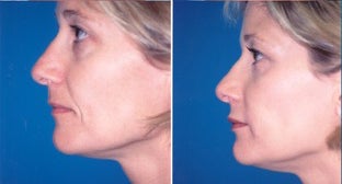 38-year-old woman treated with Facial Fat Transfer. after 3282135