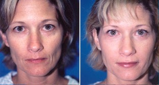38-year-old woman treated with Facial Fat Transfer. before 3282135
