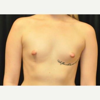 18-24 year old woman treated with Breast Augmentation before 1719115