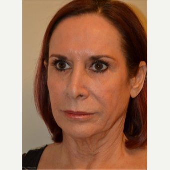 55-64 year old woman treated with Neck Lift before 3664437