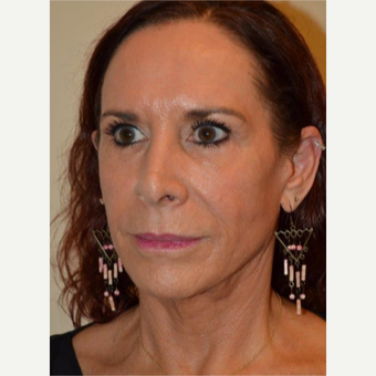 55-64 year old woman treated with Neck Lift after 3664437