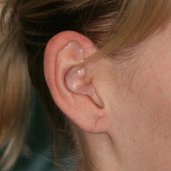 25-34 year old woman treated with Ear Lobe Surgery after 1683169