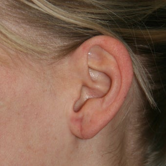 25-34 year old woman treated with Ear Lobe Surgery 1683169
