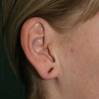 25-34 year old woman treated with Ear Lobe Surgery before 1683169
