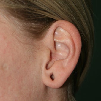 25-34 year old woman treated with Ear Lobe Surgery 1683169