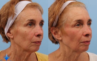 65-74 year old woman treated with Wrinkle Treatment before 3623753