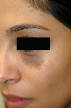 Birthmark Removal Nevus of Ota Before and After Photos before 1199545