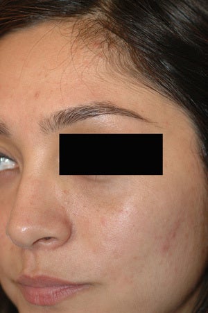 Birthmark Removal Nevus of Ota Before and After Photos after 1199545