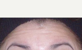 45-54 year old woman treated with Botox before 3089294