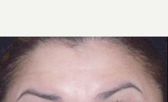 45-54 year old woman treated with Botox after 3089294