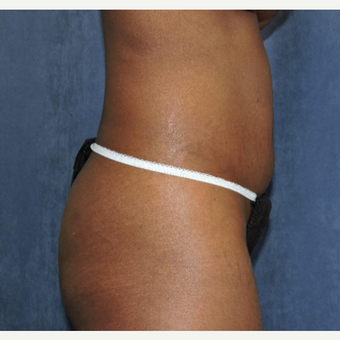 25-34 year old woman treated with Brazilian Butt Lift before 3683699