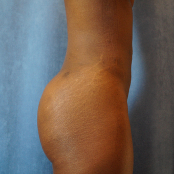 25-34 year old woman treated with Brazilian Butt Lift after 3683699