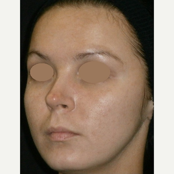 25-34 year old woman treated with IPL after 3161887