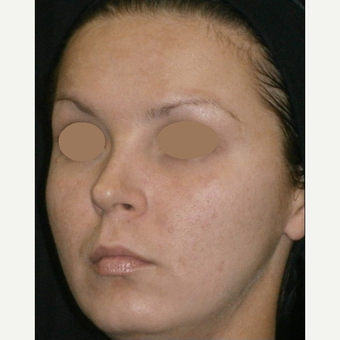 25-34 year old woman treated with IPL before 3161887