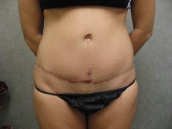 Tummy Tuck Revision before 934930