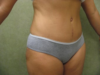 Tummy Tuck Revision 934930