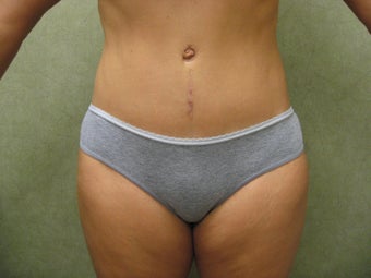 Tummy Tuck Revision after 934930
