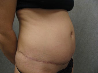 Tummy Tuck Revision 934930