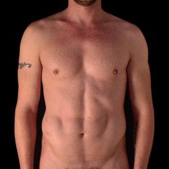35-44 year old man treated with Body Jet after 2539191