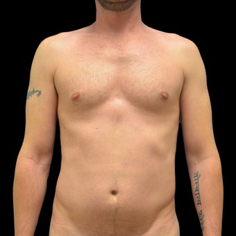 35-44 year old man treated with Body Jet before 2539191