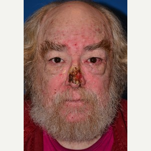 55-64 year old man treated with Mohs Surgery before 3389239