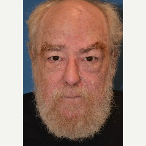 55-64 year old man treated with Mohs Surgery after 3389239