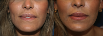 Lip augmentation female before 1114499
