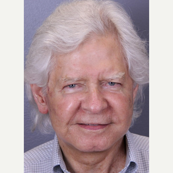 Man treated with Facelift, Upper Blepharoplasty, Fillers and Laser Resurfacing after 1807767