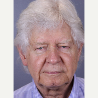 Man treated with Facelift, Upper Blepharoplasty, Fillers and Laser Resurfacing before 1807767