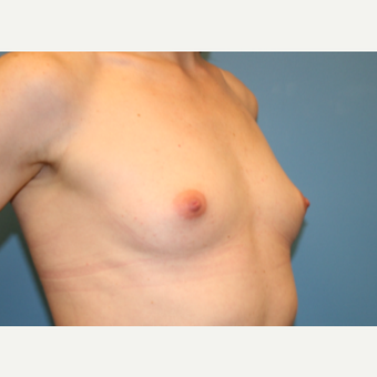 29 year old woman treated with Breast Augmentation before 3486696