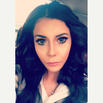 26 years old woman treated with Rhinoplasty, chin and cheek implant after 3648973