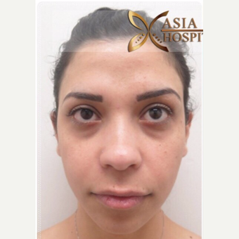 26 years old woman treated with Rhinoplasty, chin and cheek implant before 3648973