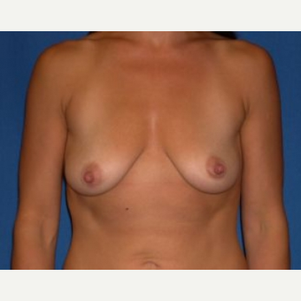 35-44 year old woman treated with Breast Augmentation before 3009171