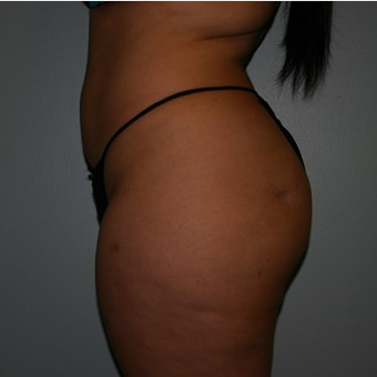 Brazilian Butt Lift before 3667603