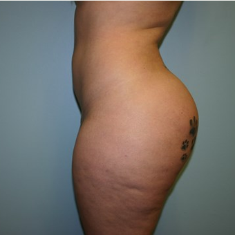 Brazilian Butt Lift after 3667603