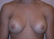 Breast Augmentation with Silicone Gel Implants before 1398150