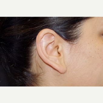 35-44 year old woman treated with Ear Lobe Surgery before 3055252