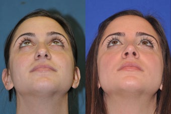 Rhinoplasty before 256043