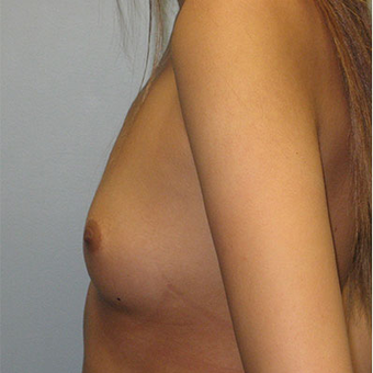 25 year old woman treated with Breast Augmentation before 3468366