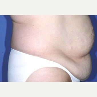Mom feels so much better after Tummy Tuck and Liposuction of lower flanks. before 2246252